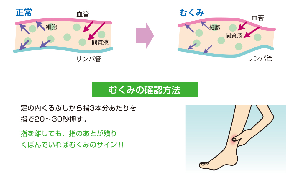 むくみの確認方法